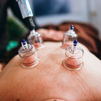 Gallery Photo of Cupping