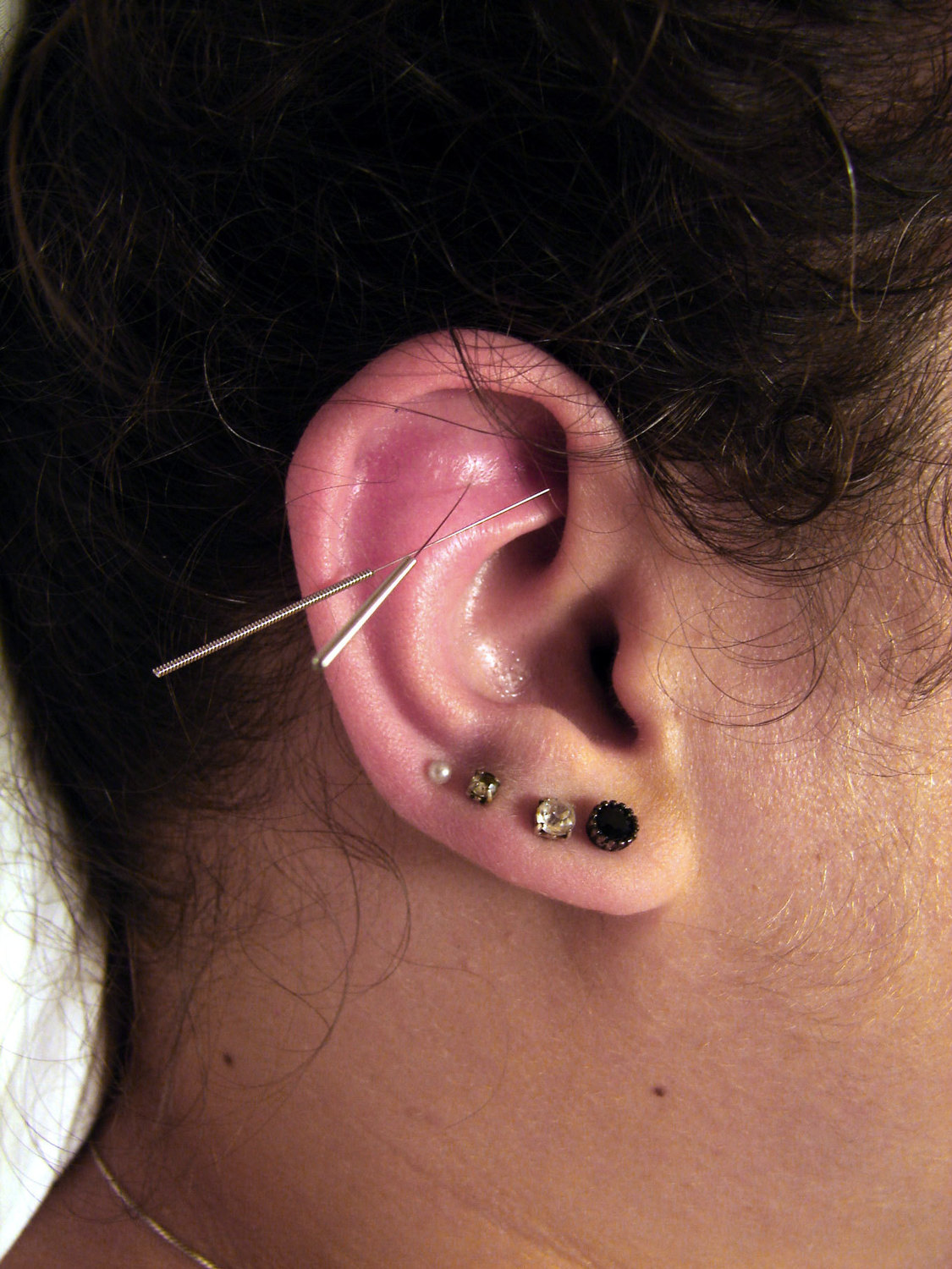 Gallery Photo of auricular acupuncture