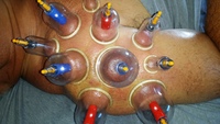 Gallery Photo of massage cupping for shoulder pain