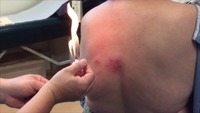 Gallery Photo of Fire needling acupuncture