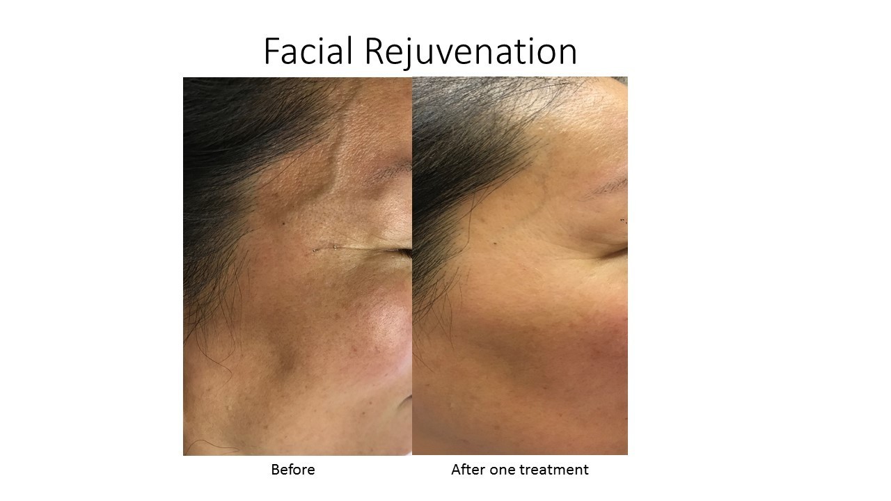 Gallery Photo of Facial Rejuvenation