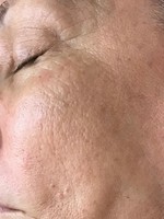 Gallery Photo of After 3 treatments of facial rejuvenation