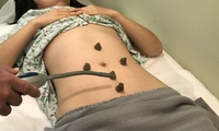 Gallery Photo of Moxa therapy for increase metabolism and warm the meridians