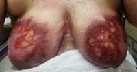 Gallery Photo of Open wounds from auto immune disease after baby birth, she went emergency room 4 times last 4 months. There is no treatment available..
