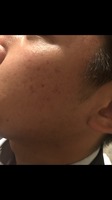 Gallery Photo of Pimples and skin disease Feb 2018