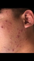 Gallery Photo of Inflammation of the face and upper back pimples and skin disease Nov 2017