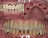 Gallery Photo of Upper Implant Reconstruction