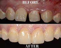 Gallery Photo of Teeth Bonding