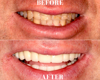 Gallery Photo of Smile Makeover