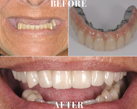 Gallery Photo of Upper Implant Reconstruction