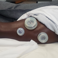 Gallery Photo of Decompression Cupping